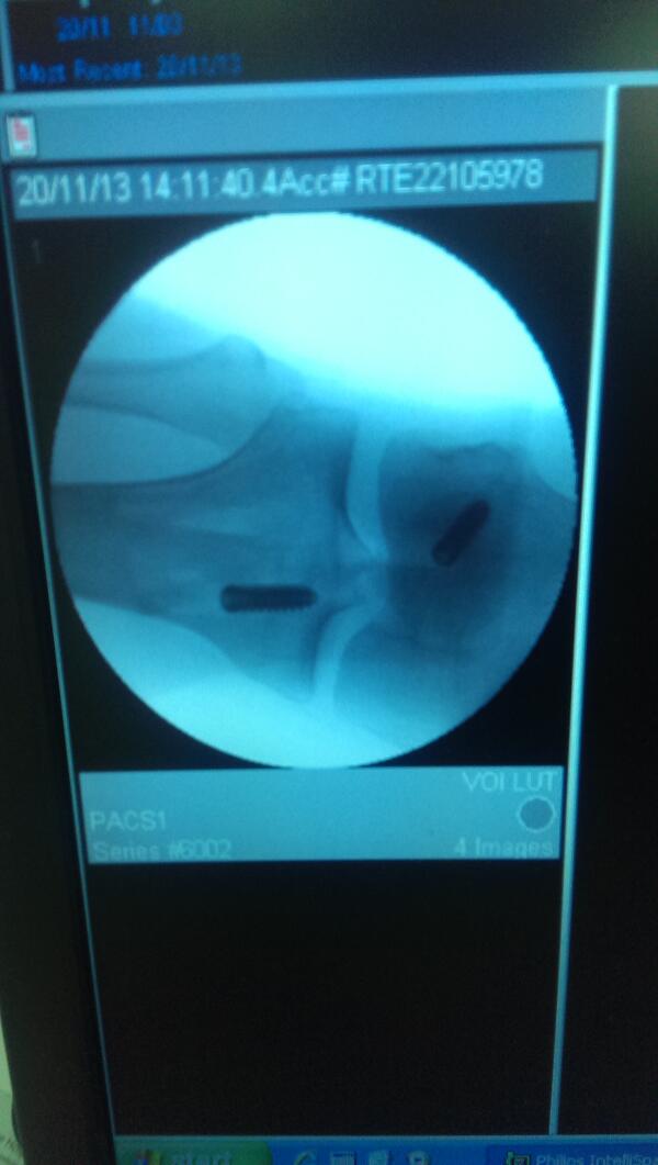 ACLrecoveryBlog's tweet photo. The screws r a bit bigger than I thought! http://t.co/fiiatyKyri