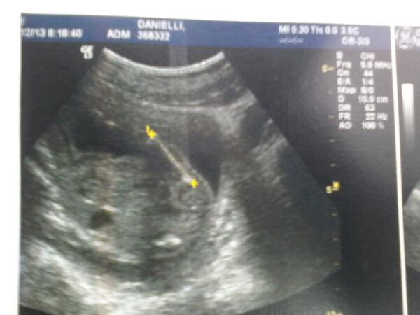 dani_isj's tweet photo. Fotinha do meu bebezão,que ficou de costas no ultrasom sz te amo meu TUDO,&amp; Bruno Romano Rodrigues eu te amo Papai". http://t.co/35c7GllsIh