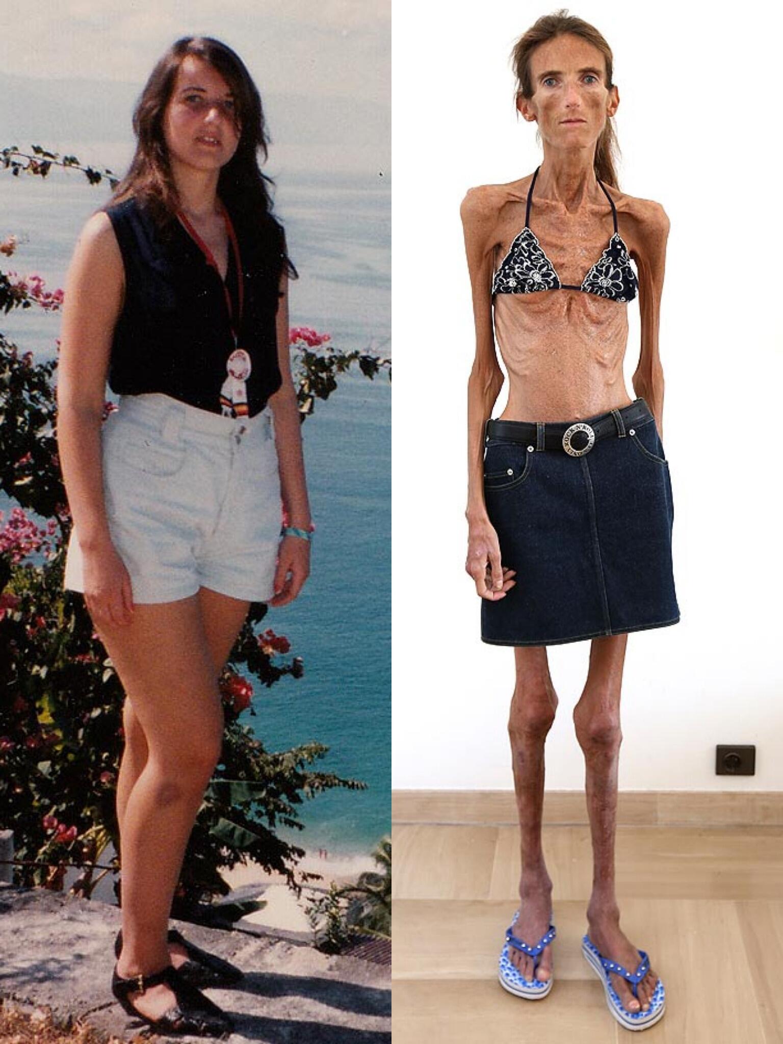 話題のワールド芸能ネタ ダイエットしすぎて身長172cmの女性が体重25kgに 現在はモナコで生活をするロシア人 の女性 ヴァレリアは 過度な食事制限により摂食障害を患っている 拒食症 患者の1人 Http T Co Ha1ubh1mp8 Twitter