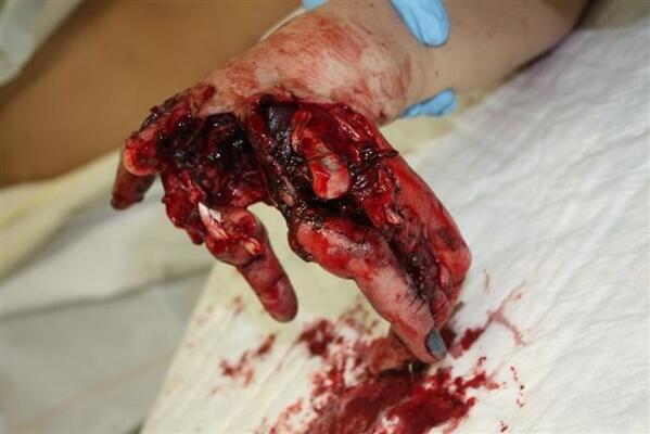 RT  Eerste slachtoffers #illegaal #vuurwerk zijn reeds gevallen in NL....Wil jij de volgende zijn......