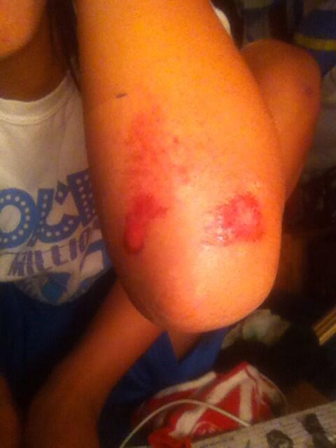 Its_Coral_'s tweet image. #armupdate no plaster needed for now xx