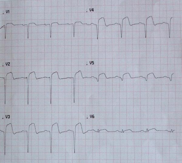 umanamd's tweet image. Had chest pain 2 days ago. Since then, asymptomatic. Came in just to refill antiHT meds…
#codeSTEMI