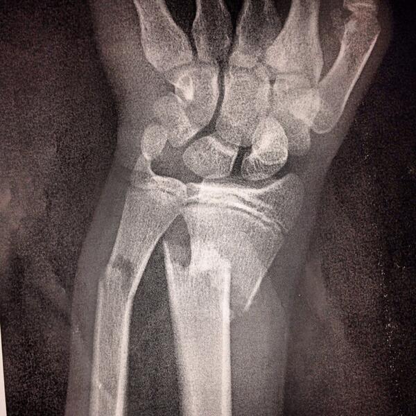 TerrinVavra2's tweet image. X-Ray number 1 #doublebreak