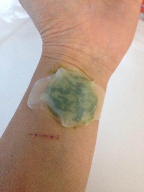 Twitter 上的 古屋兎丸 即効性はないとわかりつつも扁桃腺をなんとかしたいので仙人草治療を始めました この後 奇妙な水疱ができます どこかの民間治療らしいのですが 少なくともこの3年間 扁桃腺はあまり腫れませんでしたよ 苦しんでる方は試してみて下さい Twitter 上的 古屋兎丸 即効性はないとわかりつつも扁桃腺をなんとかしたいので仙人草治療を始めました この後 奇妙な水疱ができます どこかの民間治療らしいのですが 少なくともこの3年間 扁桃腺はあまり腫れませんでしたよ 苦しんでる方は試してみて下さい