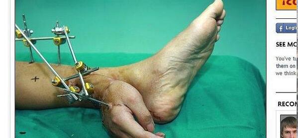 hoyextremadura's tweet photo. Le implantan una mano en el pie para mantenerla con vida . hoy.es http://t.co/dnghlRmlwM vía @hoyextremadura http://t.co/FKAfHT46P0