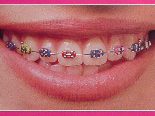 W唐揚げを揚げる女w 昔 歯列矯正してたけど D 下の前歯がズレてきて 綺麗に矯正 したいなぁー ๑ ㅁ ๑ またしたくなってきた 今はこんなにカラフルで可愛い矯正ができるんだね いいなぁー 矯正すごく痛いけどしたいなぁー可愛いなぁー D