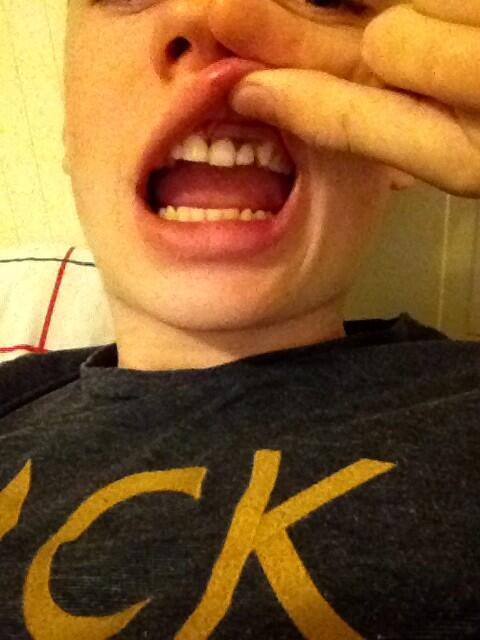 craig_lynch17's tweet image. What a day , teeth knocked in @chriscarey8 #careyd #headbut #scenes