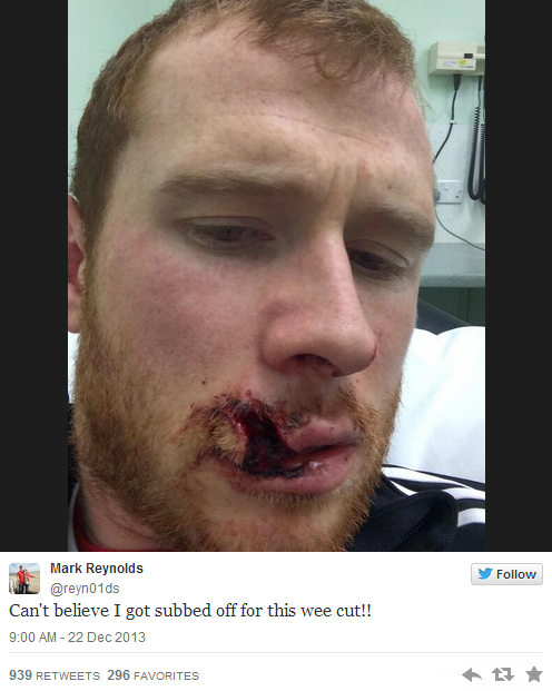 voetbalzonenl's tweet photo. Aberdeen-verdediger Mark Reynolds begrijpt niet waarom-ie gewisseld werd... #klein #scheurtje #maar http://t.co/nMHOEK1cU3