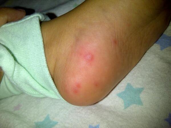 wedhyyy's tweet photo. @drtiwi @drOei @dr_ardi @dr_piprim dok,ankku 1th, kaki &amp; tangannya merah2 &amp; ada yg sperti melepuh knp ya ? http://t.co/0qvCj7X6QS