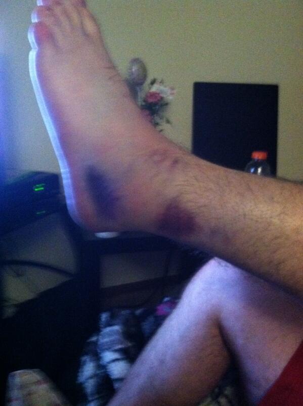 richweav's tweet photo. Sprained my ankle http://t.co/nuHCuXzgq2