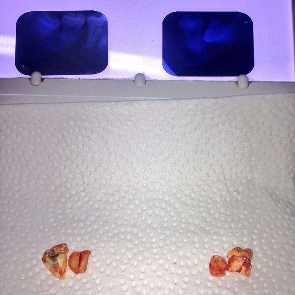 jmclinicadental's tweet photo. Cirugía de 3ros @PLUSDENTAL1 http://t.co/TyB3shHaum