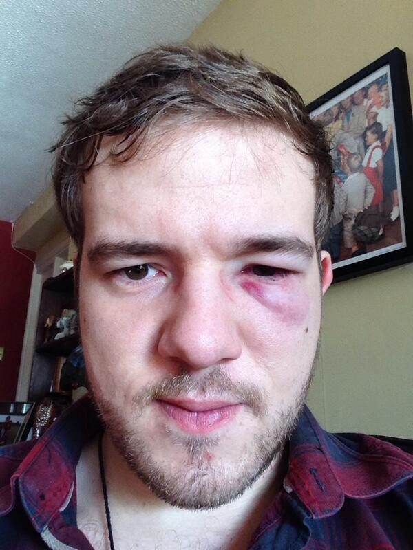 nikrgray's tweet image. Day 2 need an X-ray #fml