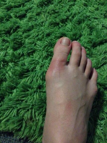 AshleyBurkman's tweet image. I've played soccer for  15 years, and I can honestly say I've never had this happen before #bruise #whythere