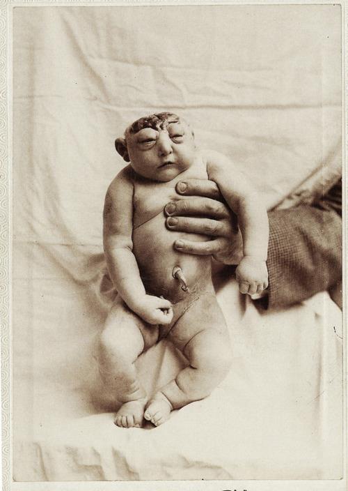 Baby anencephaly What is