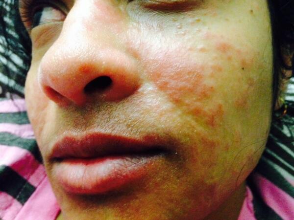 Lafiaseb's tweet photo. @palmersworks I am so disappointed by your fade cream. I applied it on my face and see the result in the photo. :( http://t.co/hoMIRbkych