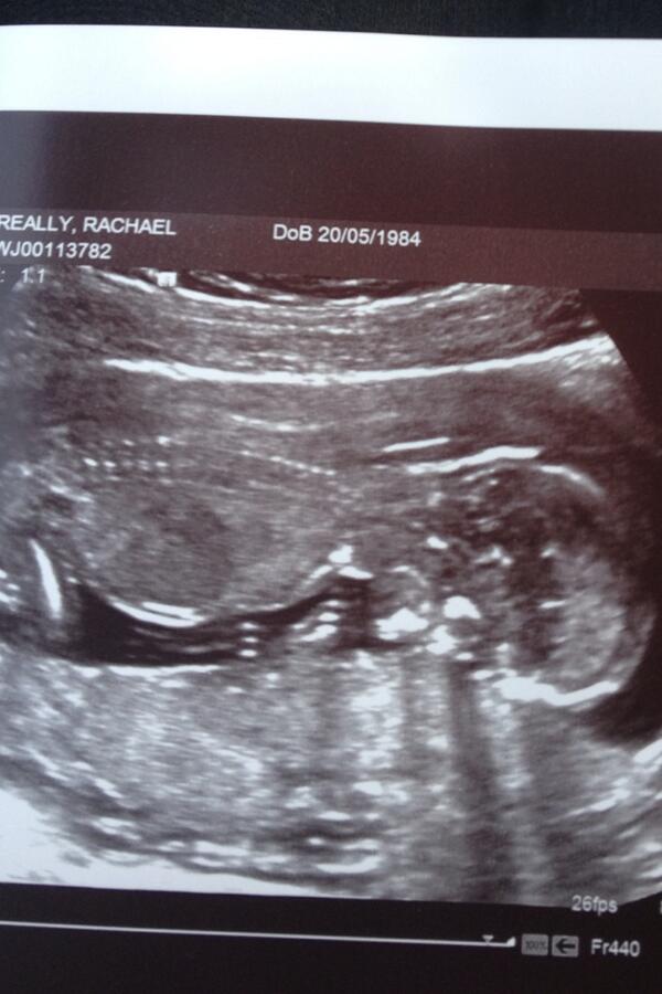 RachaelGreally's tweet photo. 14 weeks pregnant, on top of the world!! http://t.co/N0o4pS2jIJ