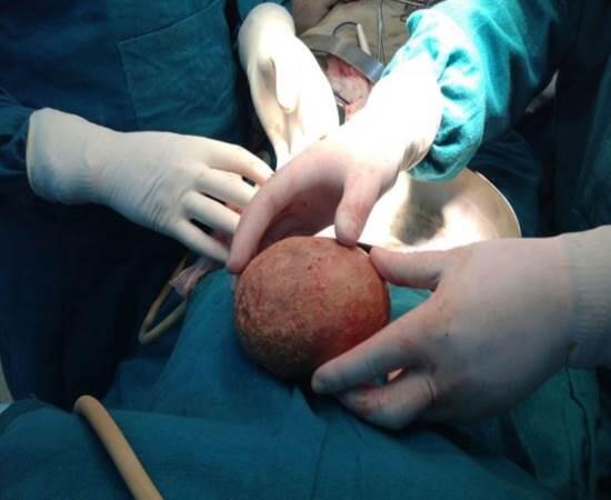 JornalCiencia's tweet photo. Paciente da Caxemira surpreendeu ao ter uma pedra de quase 1 kg retirada de sua bexiga. http://t.co/eeRNTnVuVi / http://t.co/ZtzzpNrqtT