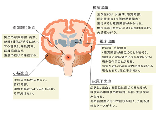 ゴロ 解剖生理イラスト Twitterissa 脳出血の場所と症状 Http T Co Monc222kgc