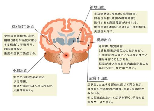 は と 脳幹 出血