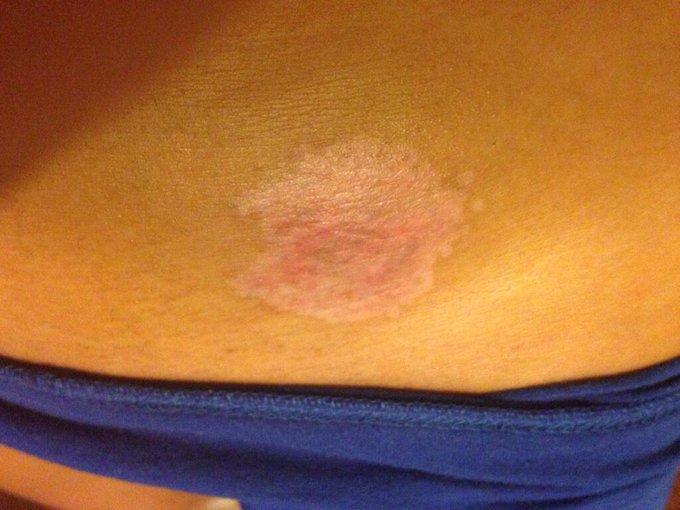 Tattoo removal update. Almost there!!!! 😜 http://t.co/IZpyaCxY99<a href="/tag/halloween"class="tags"><span>#halloween</span></a>