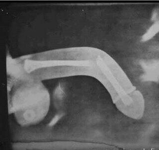 Radiografia de sexo anal