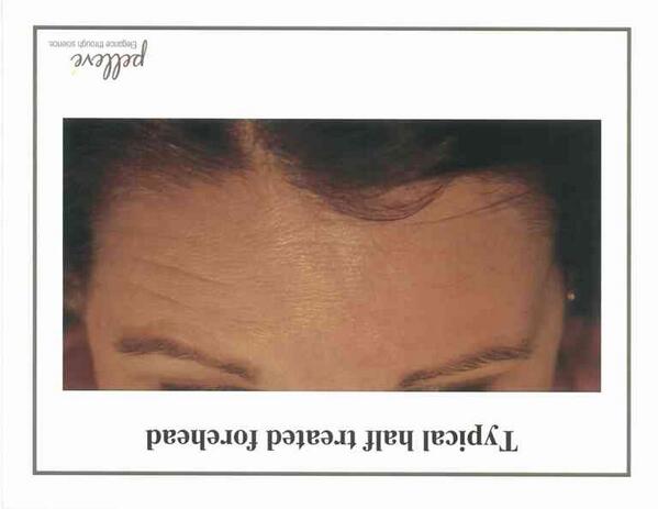 CrystalLume's tweet photo. @thumbtack Crystallume meical spa  Botox Sale Sat day Jan 18 2014 9am-12
$9 per unite 301-418-6060 http://t.co/Mk4klh2pl5