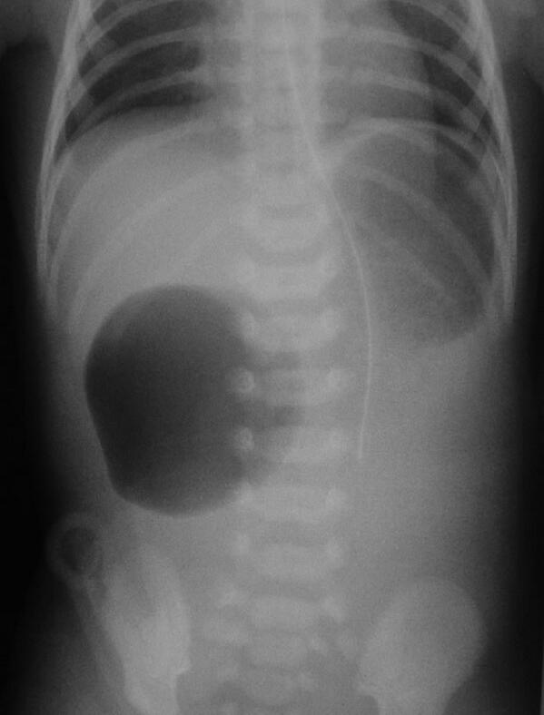 PedsBoards's tweet photo. Duodenal atresia "double bubble" with air filling a distended stomach and the blind-ended duodenum #usmle #radiology http://t.co/IdvB51SC11