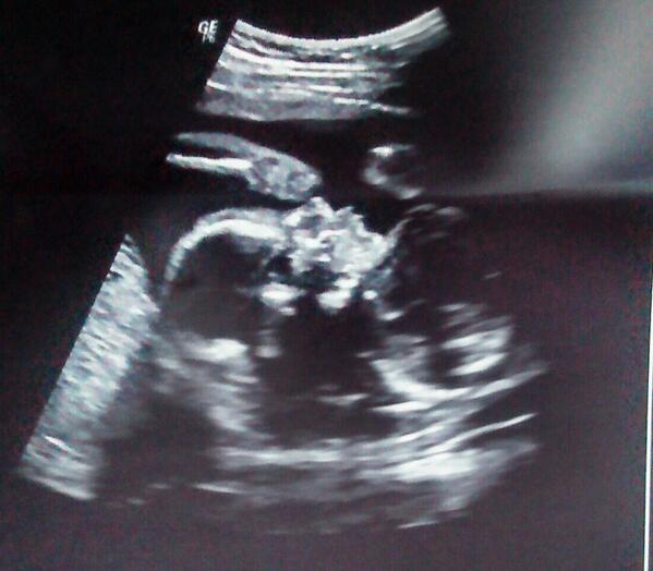 dani_isj's tweet photo. Boa tarde,mto feliz ontem fui fazer ultrassom pra descobrir o que é meu baby e descobri que é uma MeninaLinda... http://t.co/Lvl2KhTOWe