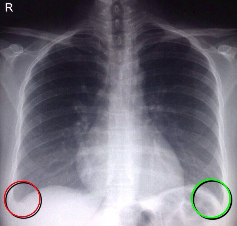 Costophrenic Angle Pleural Effusion
