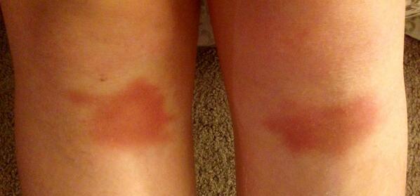 PomGirlForLife's tweet image. Practice has been very successful lately with these bruises to prove it #pomproblems #ouch