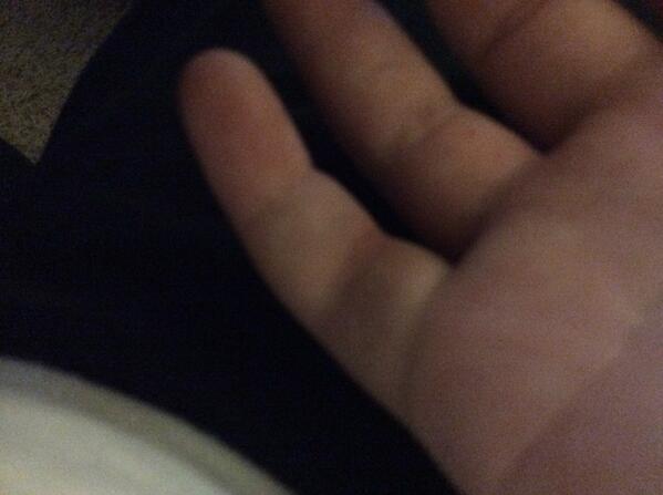 pablito_76's tweet photo. Así acaba mi dedo después de la caída del entrenamiento http://t.co/9ERTiJL4fS