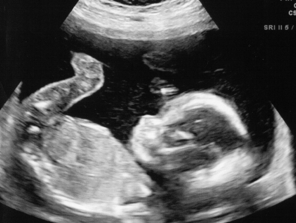18 недель мальчик. УЗИ 21 неделя беременности девочка. УЗИ 19 недель беременности мальчик. УЗИ 21 неделя беременности мальчик. УЗИ 19 недель беременности девочка.