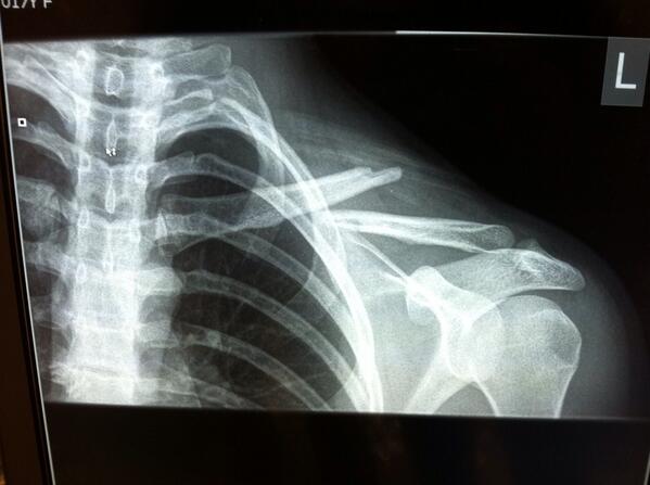 Hard loss for TC tonight and also a hard game for Grace.  Broken collarbone.  Overall a wonderful season though.