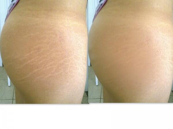 deGuerraMental's tweet photo. Remedio casero para eliminar estrías - http://t.co/JdkyzZ0H1T http://t.co/zrm3NtP4jC