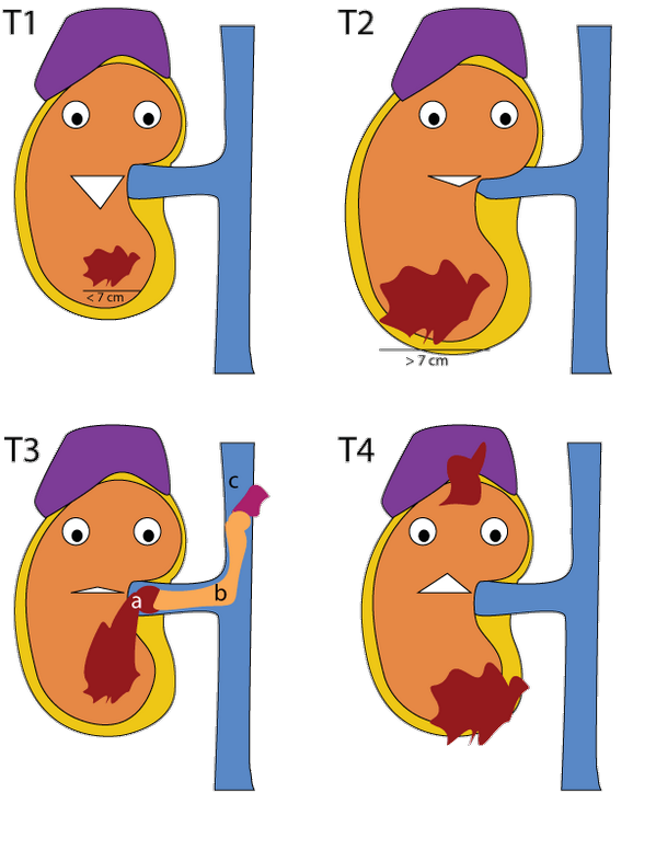 anniekey's tweet photo. Staging of renal carcinoma, in diagram form. Yes the kidney looks like it's wearing a fez. http://t.co/vXGaaQc9L9