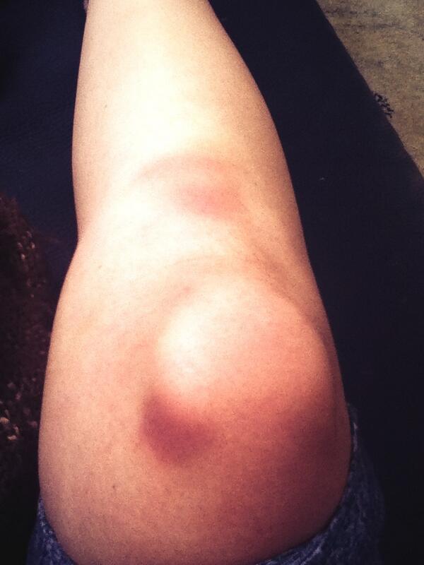 PointeProbs's tweet photo. It's that time of year again! #ouch #BalletQuotes http://t.co/dalAYOr5S5