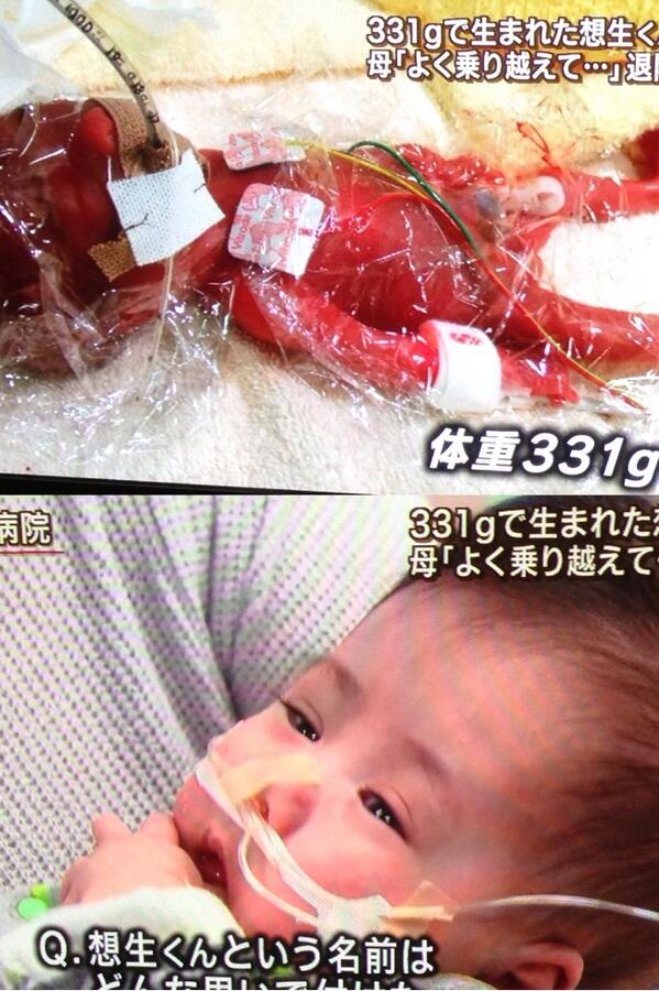 ぺぺろんろんてぃーの 331gで産まれた想生くんっていう男の子が4回の手術を経て今日退院だって 現在の体重は4 5kg 3日間生きられるかも分からないっていう状態だったらしいけど よくがんばったね これからいろんな経験をしていくんだろうな Http