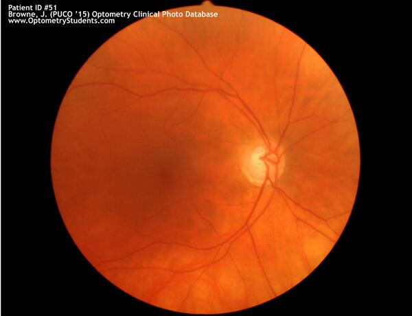 OptometryCPD's tweet photo. #Glaucoma - Full case history, visual fields, OCT images, and fundus photos on the website. Check it out! #Optometry http://t.co/xTFfHkYQwc