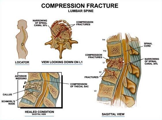 #pain #ortopedia #dolore #postura #trauma #backpain #fratture #busto #c35