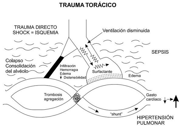 PreguntasENARM's tweet photo. Fisiopatología del SDRA :) http://t.co/th5vmtbLlg