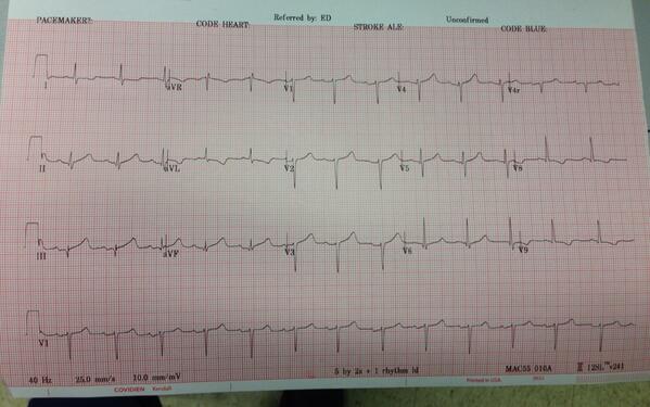 EMS12Lead's tweet image. MT @KestlerMD: Is this a STEMI? #FOAMed #CodeSTEMI (Our answer: You bet it is!)  fb.me/6iIHiRWVz