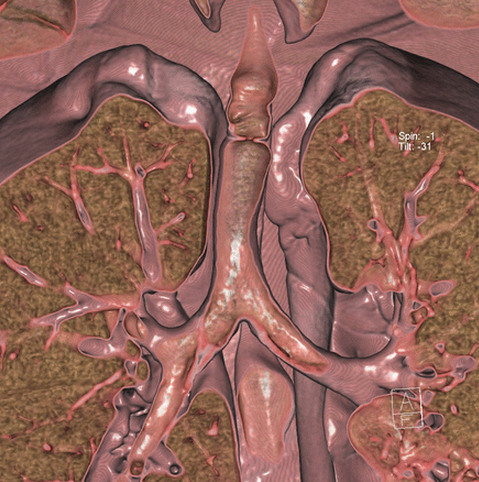 ThoraxBMJ's tweet image. New #Thorax #respiratory image: A deadly web bit.ly/1cUYyXh