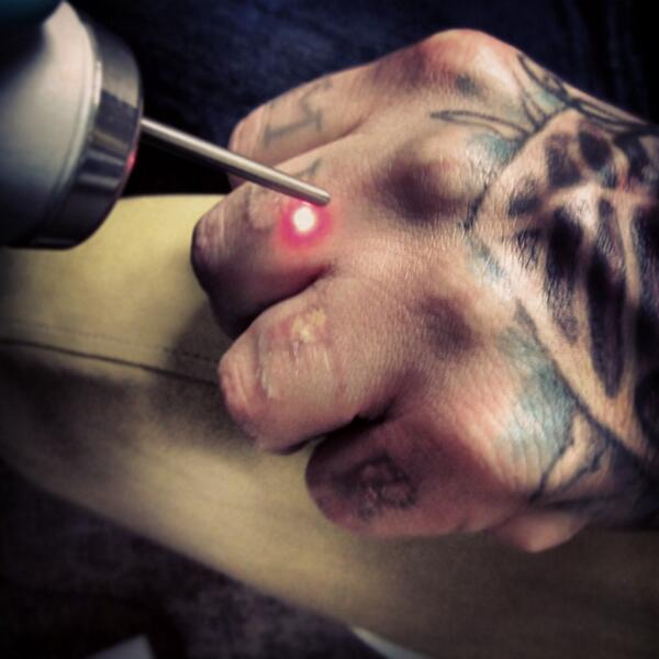 iLasertraining's tweet photo. Visit our web site for more info about our tattoo removal course http://t.co/322gxd5S92 #tattooremoval #lasertraining http://t.co/w4HmNMYEaN