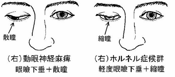 縮瞳 と は, 瞳孔が小さくなるとき – NFERC