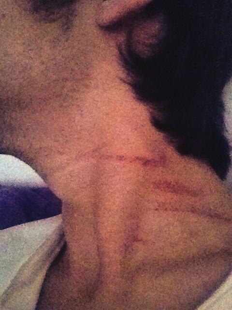 RichkidBerner's tweet photo. @schericrane gestern hart gehexnhaislt! #bär #krallen #blut http://t.co/hBkQ3xuwA4