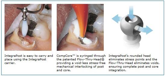 PremierDentalUS's tweet image. What is a Flow-Thru Head? See for yourself [video]  tinyurl.com/d7ftlcu #dentistry #integrapost