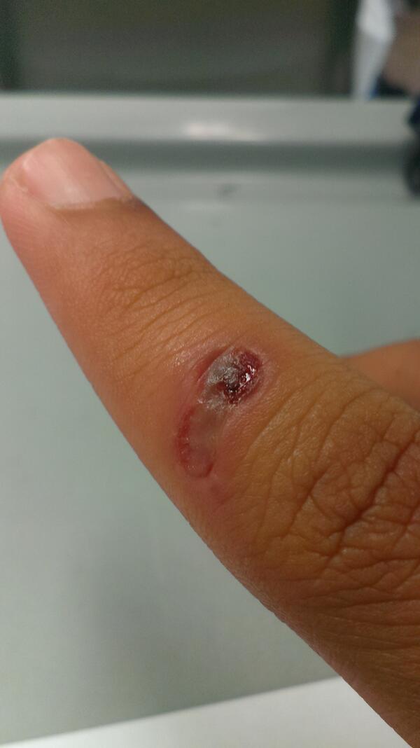 SecondOption_'s tweet image. Burned my finger