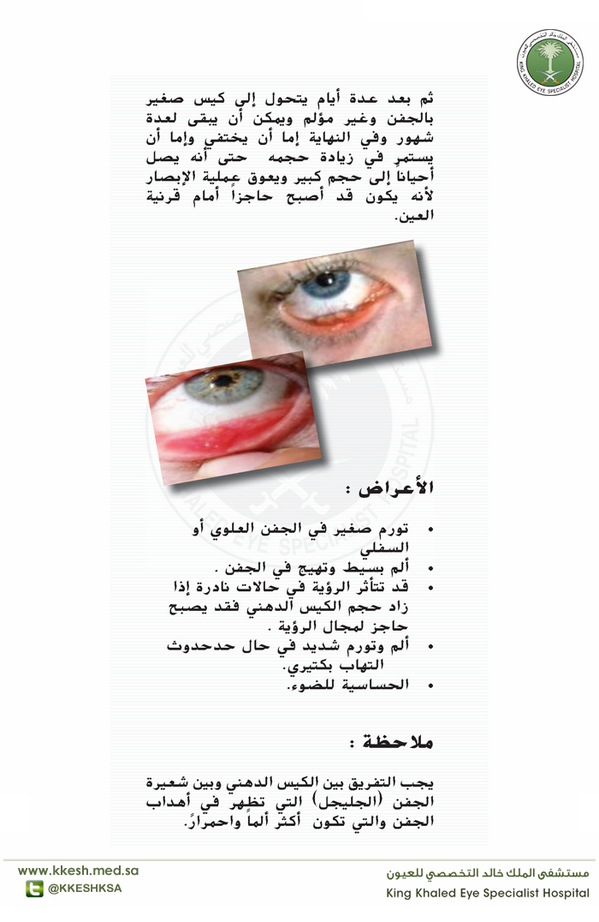 مستشفى الملك خالد التخصصي للعيون KKESH on Twitter: "الكيس الدهني في جفن  العين 2-3 #دهني #العين #العيون #الصحة #وقاية #علاج #توعية #ريتويت #السعودية  http://t.co/IQvYn7YCEb" / Twitter