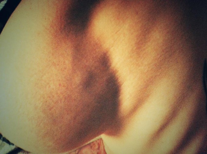 Pre-Op on Monday. #breastcancerawareness http://t.co/GKcw2MMA88<a href="/tag/breastcancerawareness"class="tags">#breastcancerawareness</a>