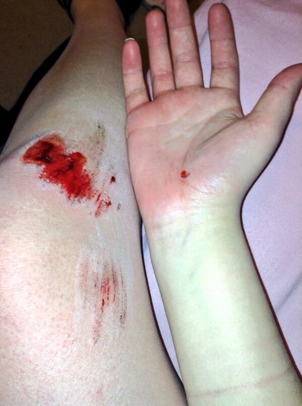 shortT33's tweet image. Reminder to self: never wear ripped jeans while longboarding. #fml #trooper #imgoodtho